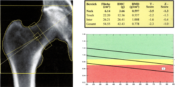 dexa_result